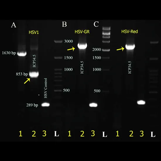 herpes simplex virus (hsv) type 1 dna pcr test